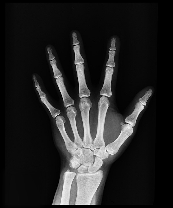 fractura mano