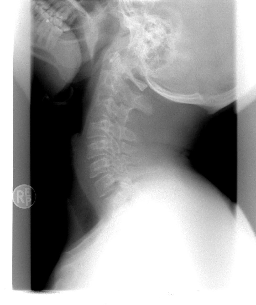 lordosis cervical causas tratamiento prevención